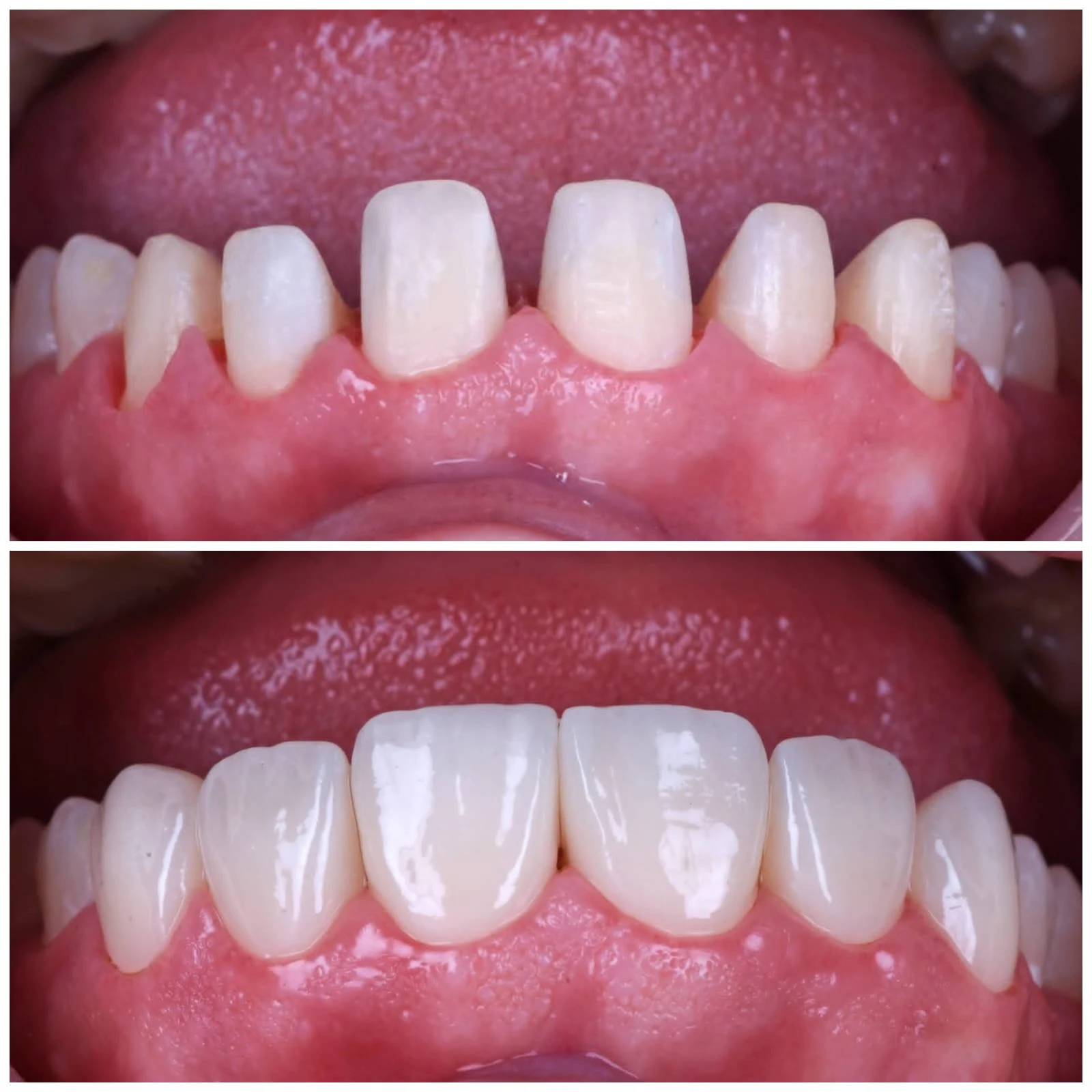 Perla Dental Team restorative dentistry before and after clinical image