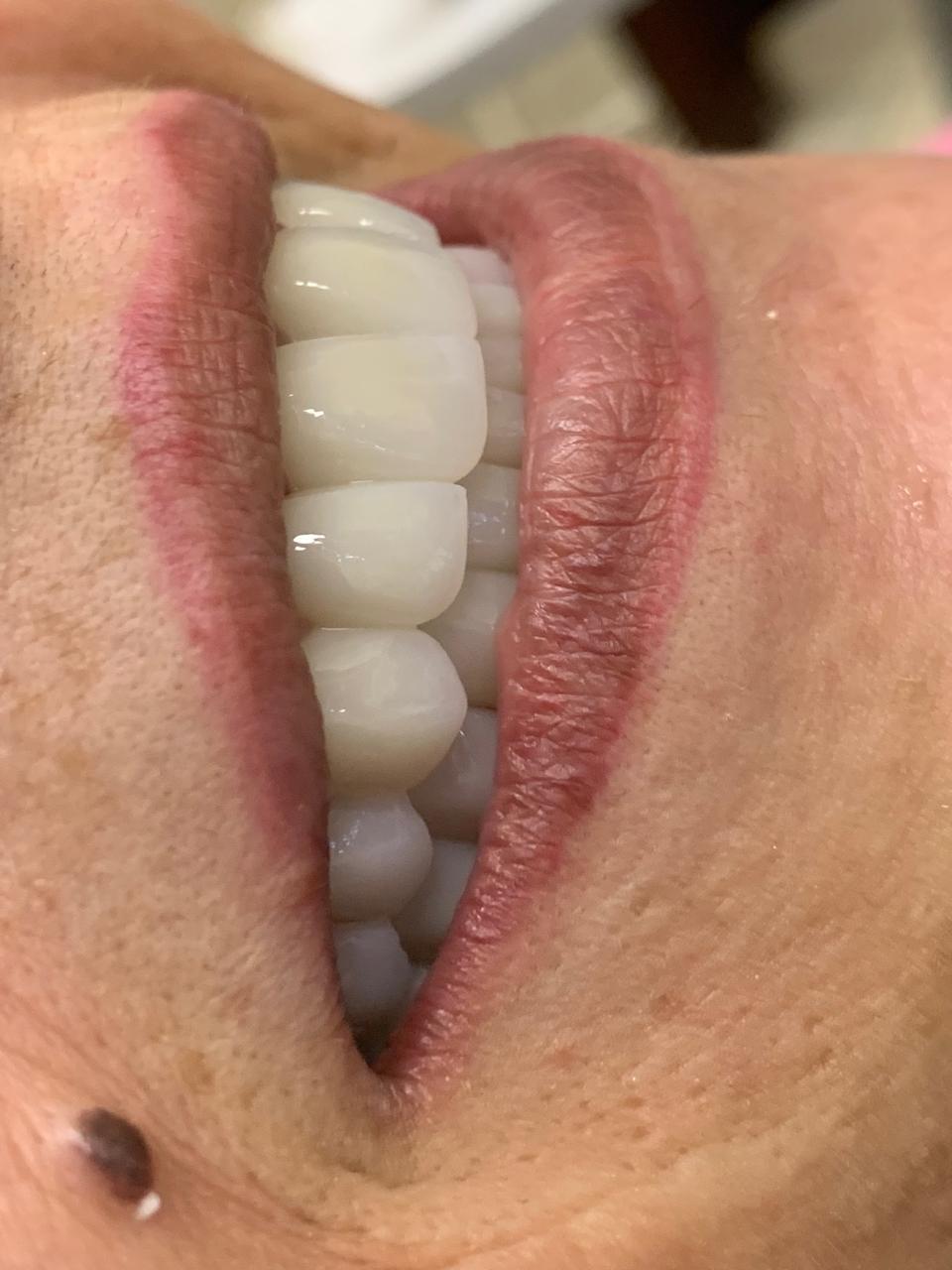 After dental treatment - beautiful white aligned smile