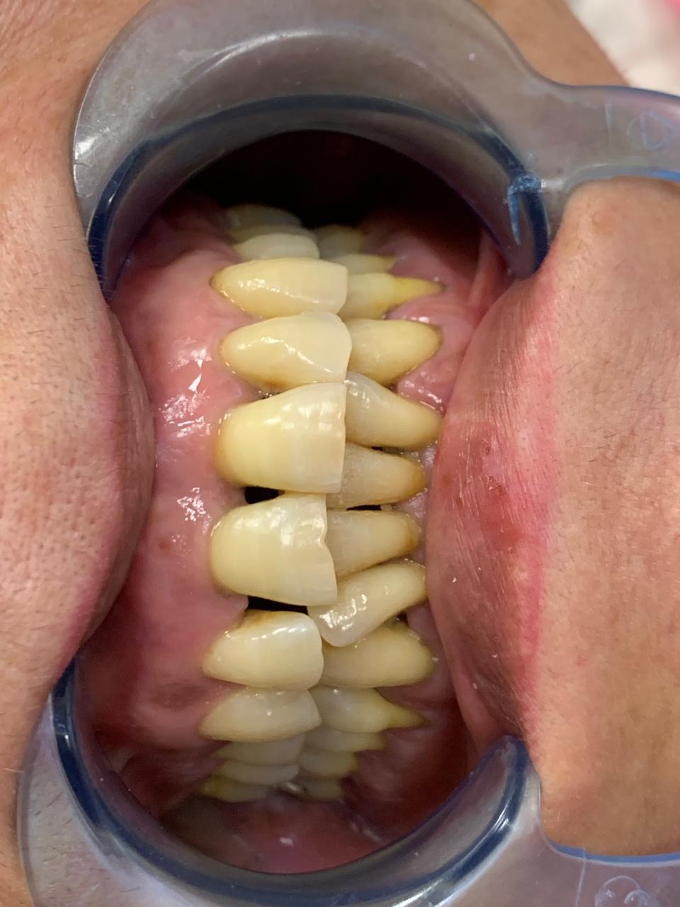 Before dental treatment - discolored and misaligned teeth